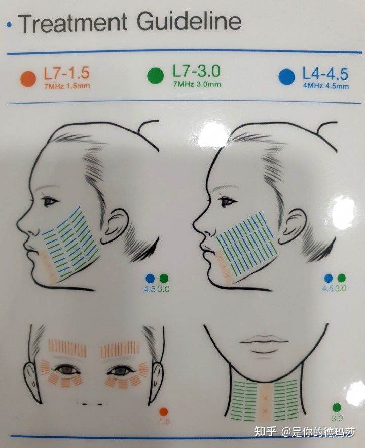 【Popular Science】 كيفية استخدام النسخة الكورية من مادة البولي يوريثين 7D والاحتياطات (SHURINK LIFTING LASER): -4